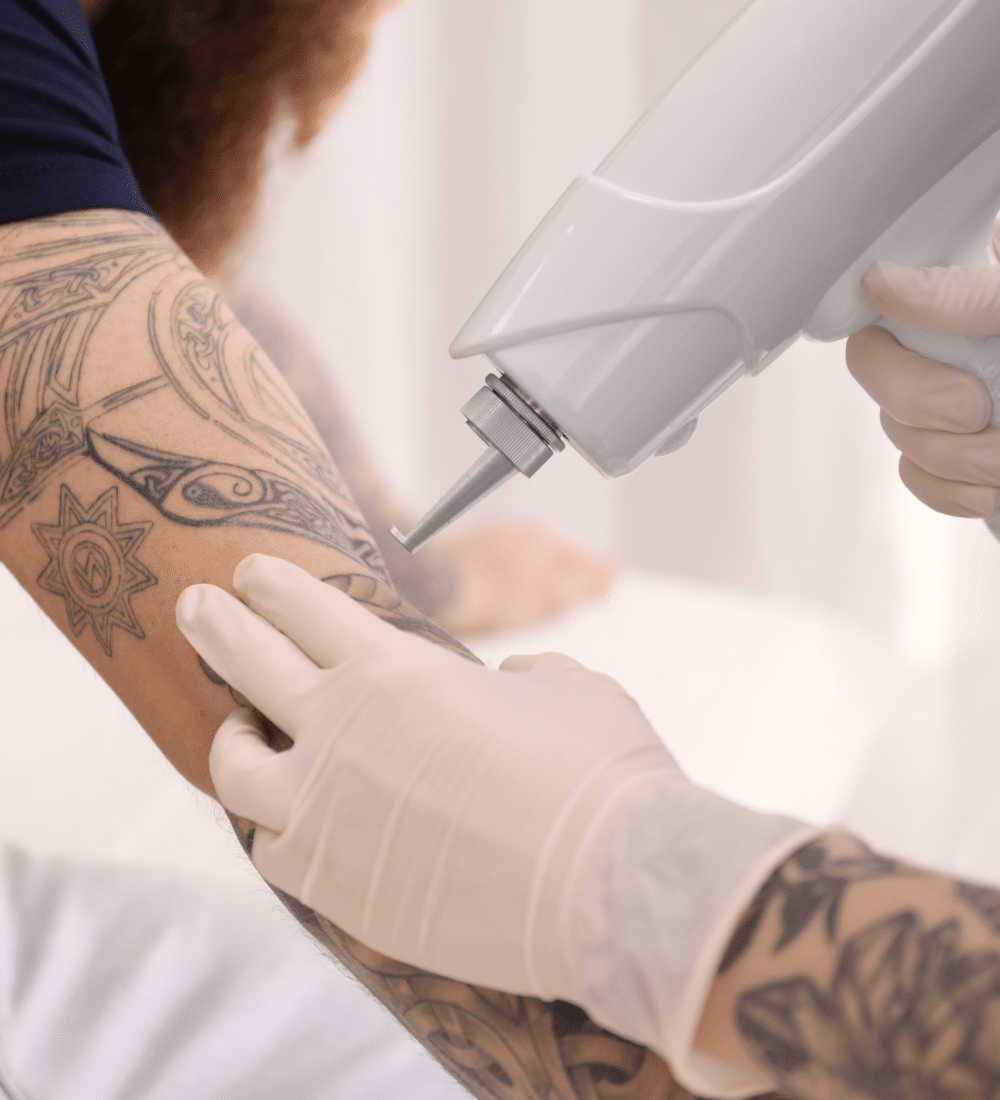 Tattoo Removal with Pico Laser Technology