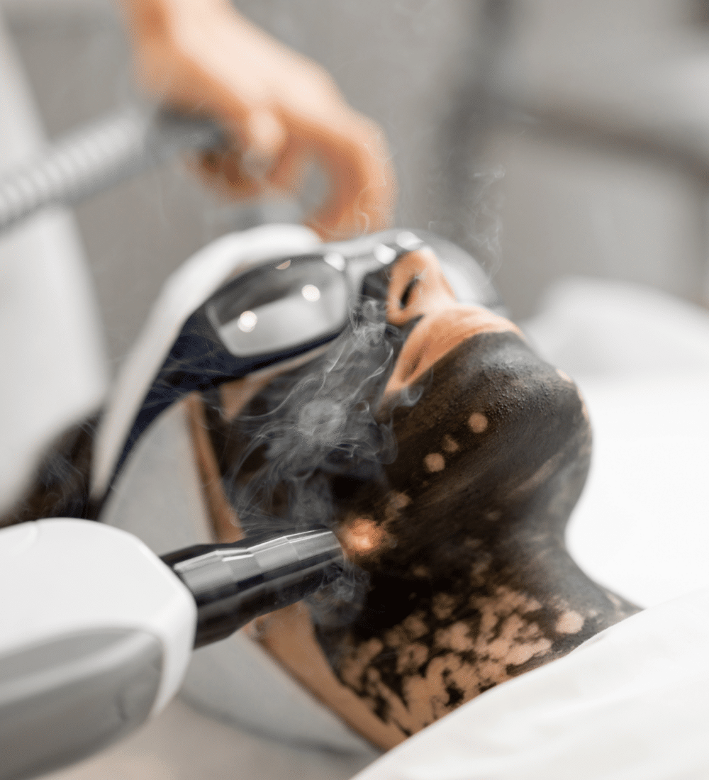 Carbon Peeling with Pico Laser Technology