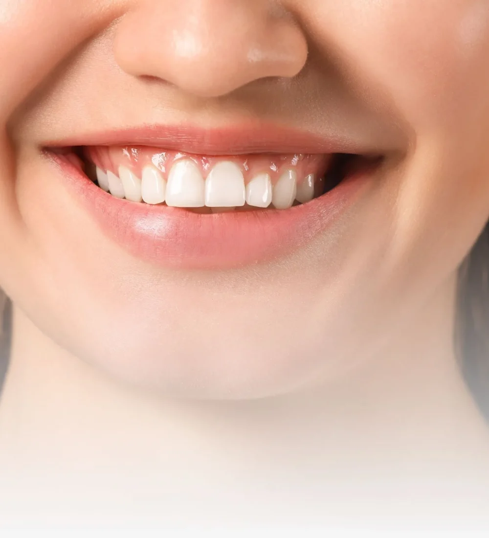 gummy smile